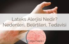 Lateks alerjisi nedir? Lateks alerjisi nedenleri, belirtileri ve tedavisi, nasıl geçer